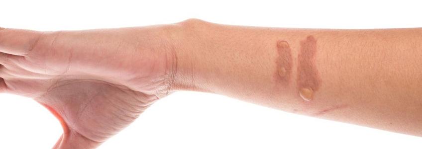 Yanık İzi Tedavisi