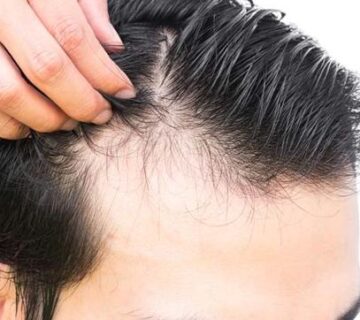 IceGraft Yöntemi ile Saç Ekimi