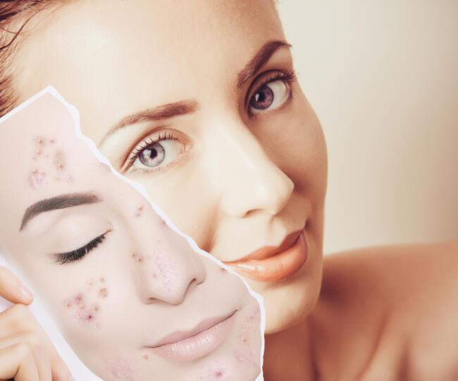 Lazerle Sivilce İzi Tedavisi