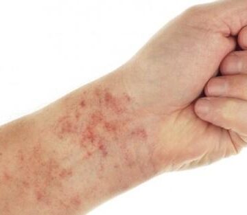 Kılcal Damar Tedavisi