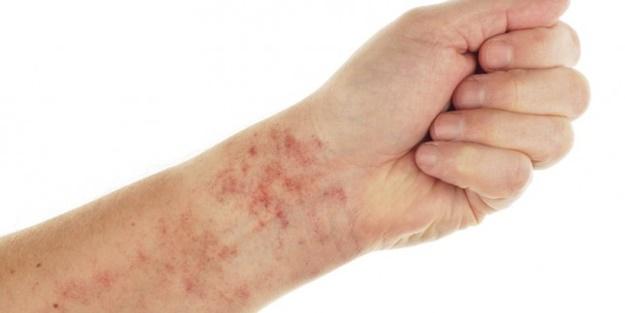 Kılcal Damar Tedavisi