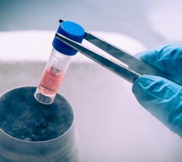 Kök Hücre Destekli Saç Ekimi