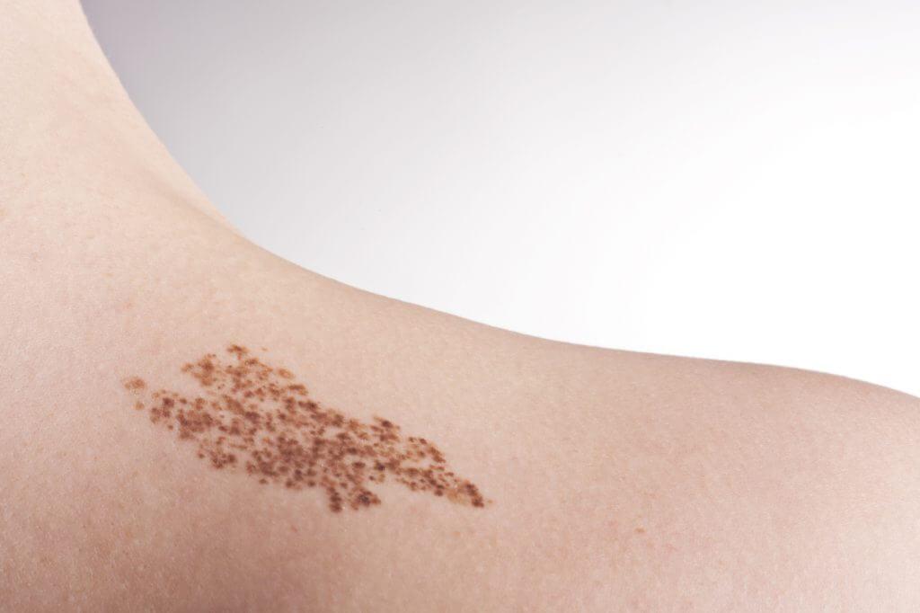 Doğum Lekesi Tedavisi