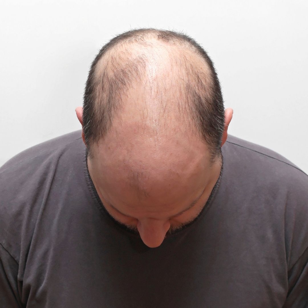 FUE Yöntemi ile Saç Ekimi Nedir