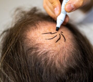 Saç Ekimi Ne Kadar Kalıcı