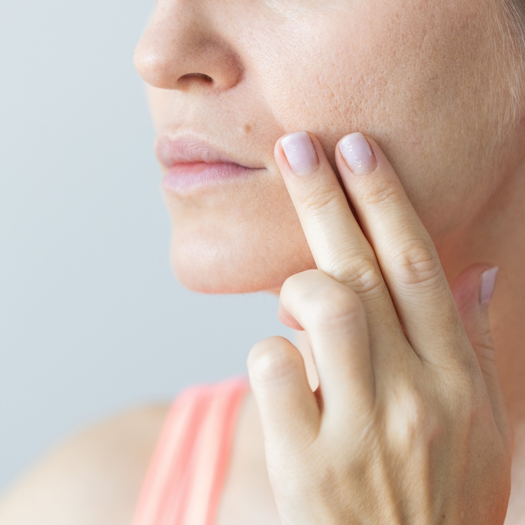 Nazolabial Çizgiler Nasıl Yok Edilir