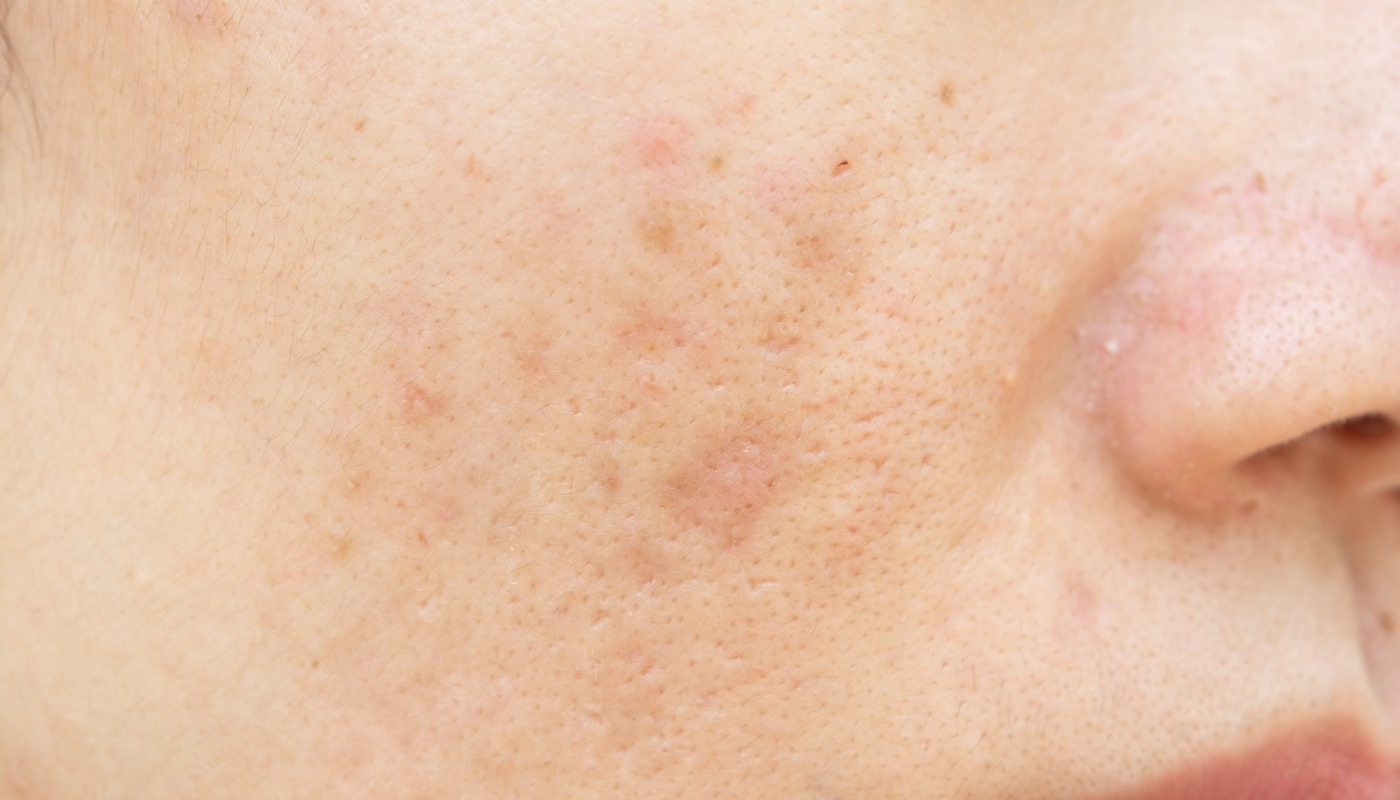 Leke Tedavisinde Hangi Yöntem Ne Zaman Tercih Edilmeli